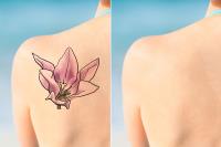 The Tattoo Removal Specialist in Melbourne image 1